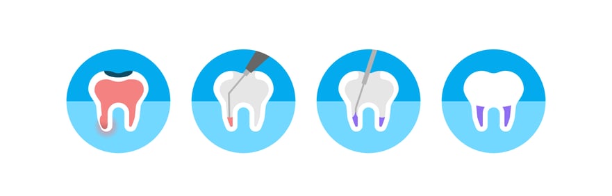 Root Canal_Blog_gaphics-01-1